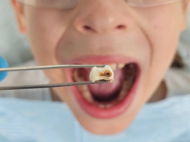 Best Root Canal Emergency Dentist  in Crandon, WI